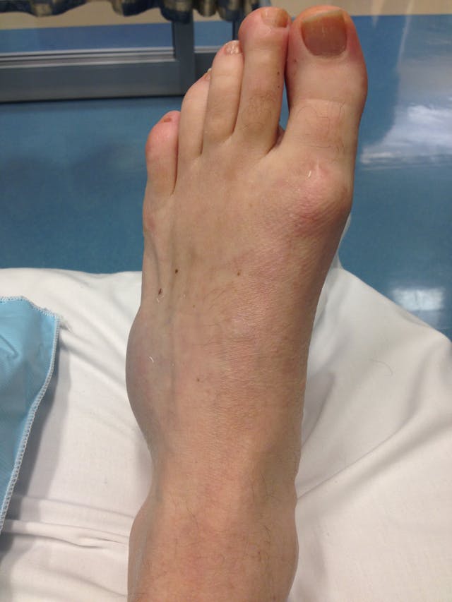 foot injury swelling