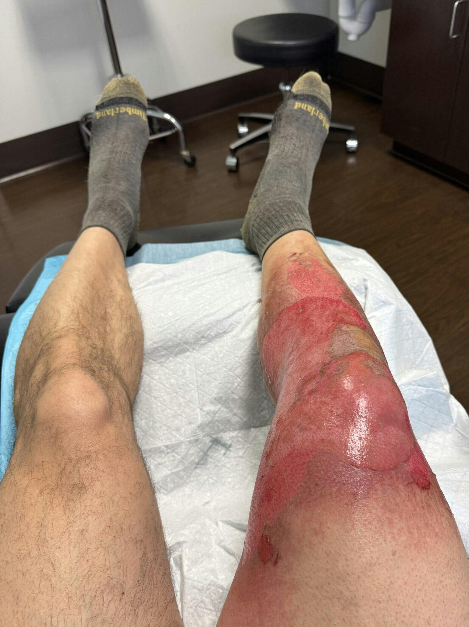 Aaron Robinson Fuel Burn Accident skin