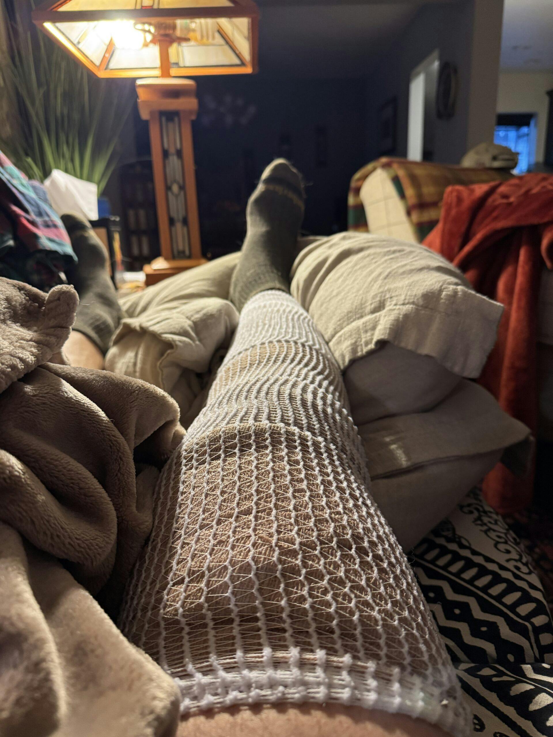 Aaron Robinson Fuel Burn Accident bandages